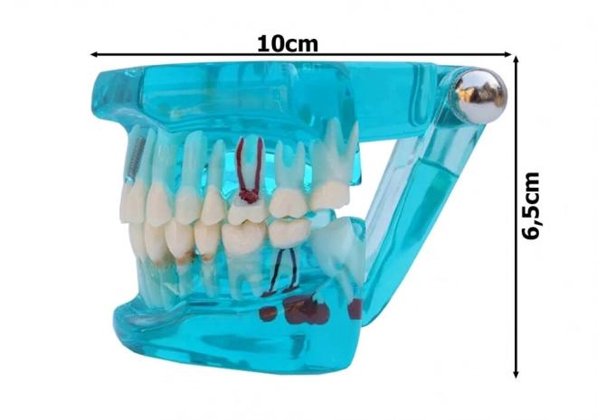 Zubní model čelisti zuby zubní implantáty