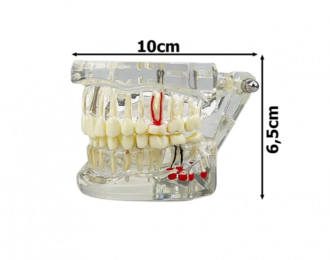 Zubní model čelisti zuby zubní implantáty